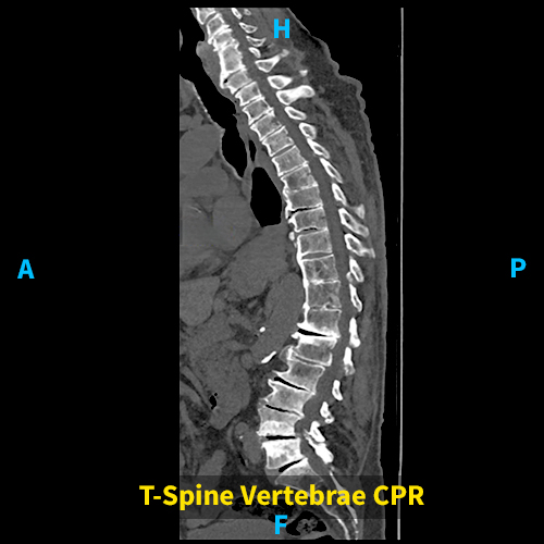 Spine