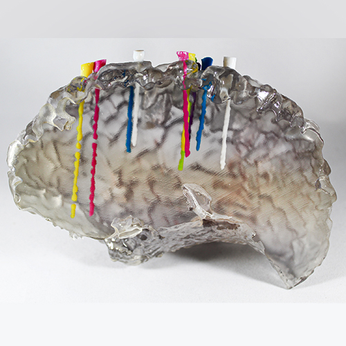 MR-CT Fusion for Epilepsy